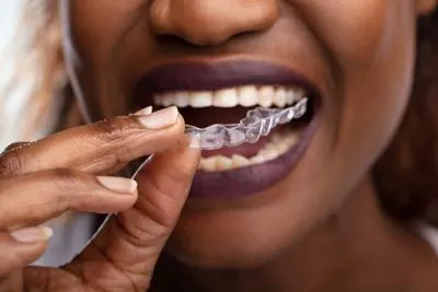 Invisalign